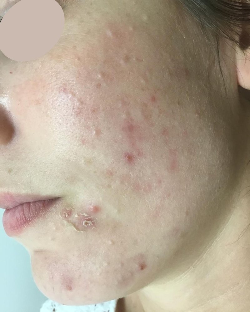 Mejilla con acné inflamatorio activo y marcas antes del tratamiento