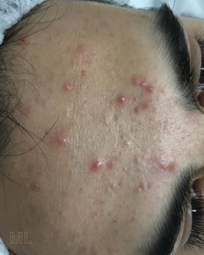 Frente y sien con acné inflamatorio activo antes del tratamiento