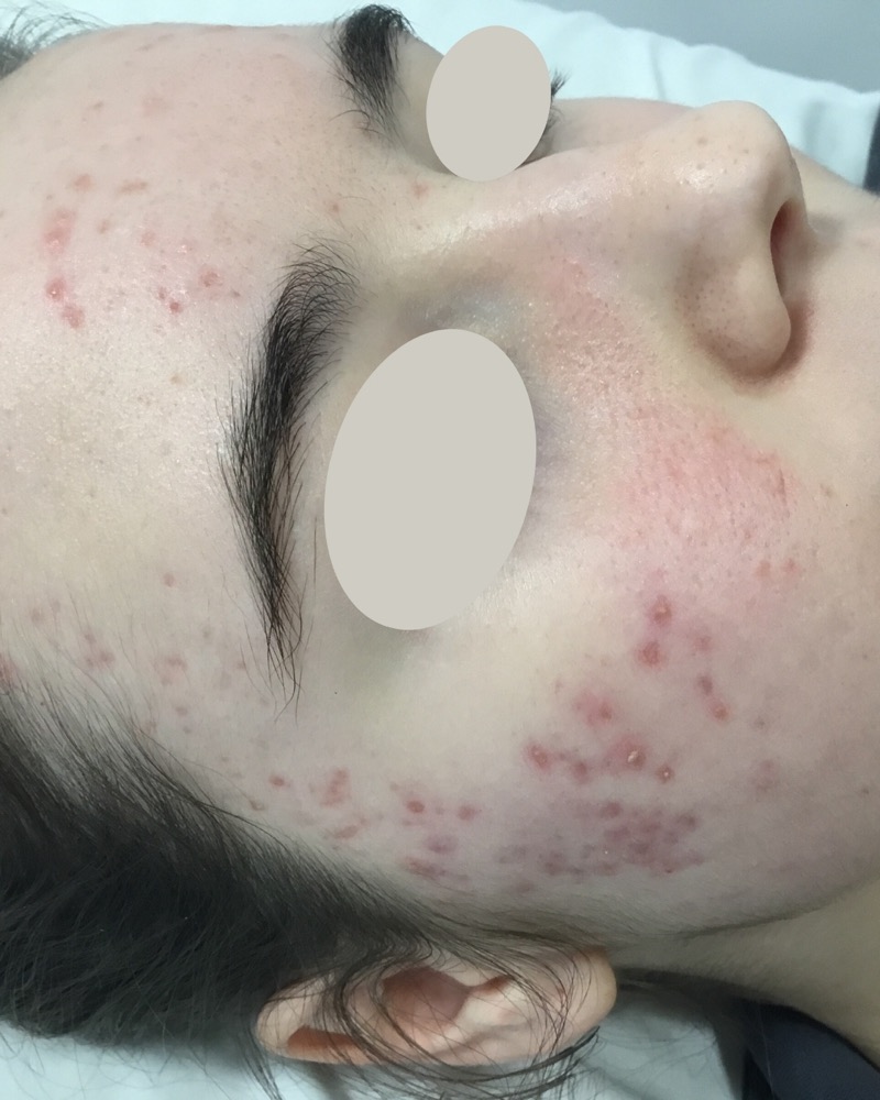Rostro con acné inflamatorio activo en mejilla y sien antes del tratamiento