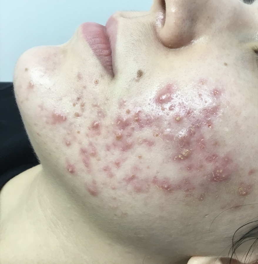 Mandíbula con acné inflamatorio activo antes del tratamiento
